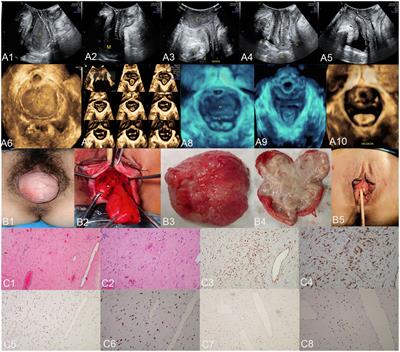 Misleading clinical and imaging features in atypical aggressive angiomyxoma of the female vulvovaginal or perianal region: report of three cases and review of the literature